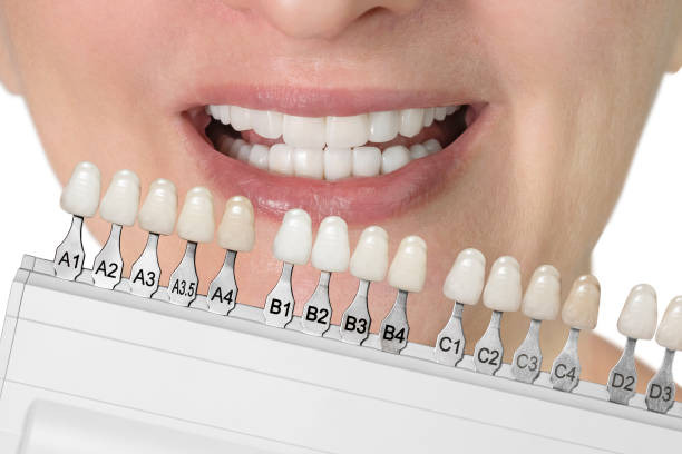 teeth palette comparison to real teeth for dental crowns