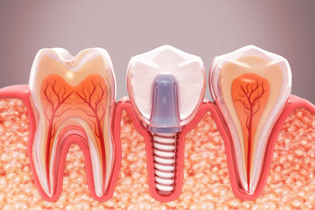 digital image of a dental implant between two teeth