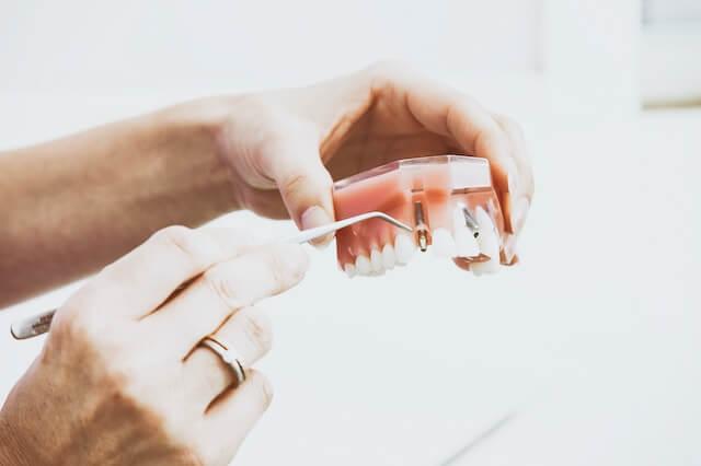 a pair of hands holding a dental model showing the implants