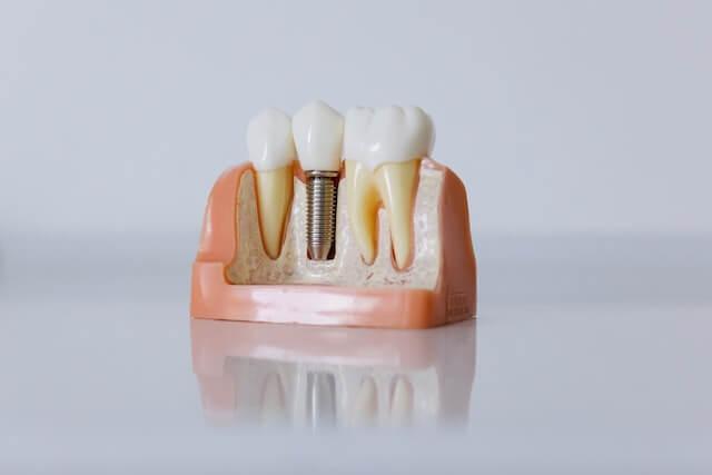 a dental implant model between two normal tooth